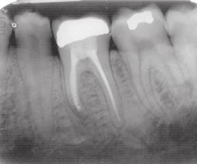 corrected and the tooth is not amenable to surgery (apicoectomy/intentional