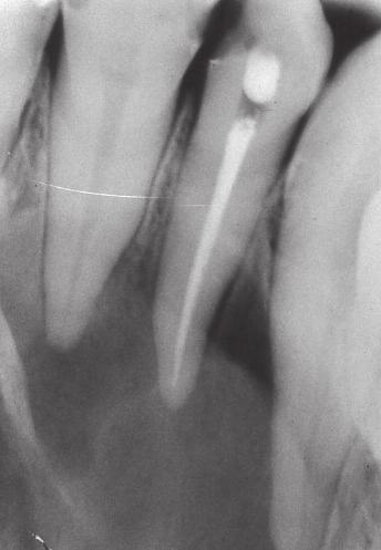 nonsurgical or surgical endodontic treatment.