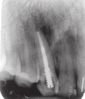 nonsurgical treatment Questionable: Pulp necrosis and a periapical lesion is present