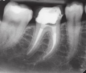 favorable outcomes Able to retrieve nonsurgically or surgically if periapical pathosis is present Defect correctable with apical surgery Questionable: