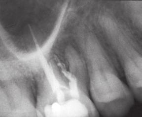 #30 exhibiting a fractured instrument in the mesial root; recall examination demonstrates a successful outcome 24 mo.