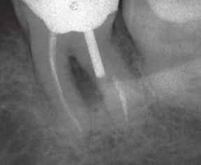Treatment Options for the Compromised Tooth Previously Endodontically Treated Tooth Procedural