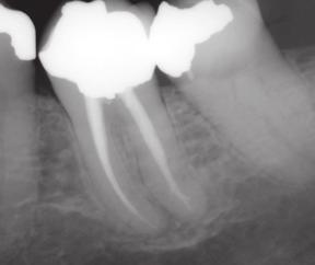 removal compromises the remaining tooth structure Teeth that cannot be retreated or treated