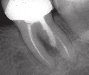 Questionable: No sulcular communication but osseous destruction is evident The perforation can be