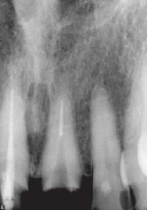 Recall Retreatment: Post Removal, Silver Points, Paste Posts With the use of modern endodontic