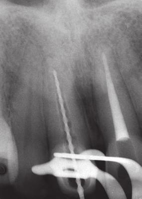 Treatment Options for the Compromised Tooth Previously Endodontically Treated Tooth Retreatment: Post