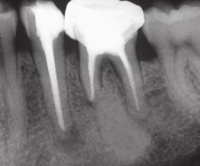 With the use of modern endodontic techniques most filling materials can be retrieved with minimal