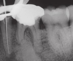 prognosis is unfavorable Silver Point Retreatment Tooth #9 treated 25 years ago requiring retreatment
