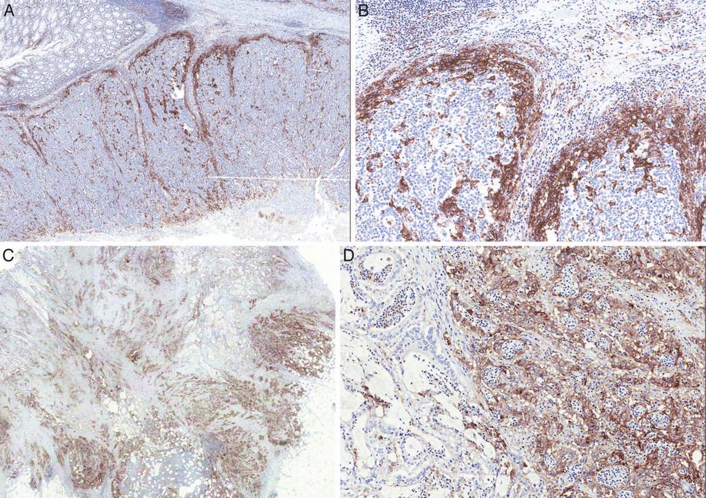 Figure 4. PD-L1 expression in microsatellite instability high (MSI-H) colorectal cancer (CRC). A and B, Strong membranous expression is shown, especially along the tumor-stromal interface.