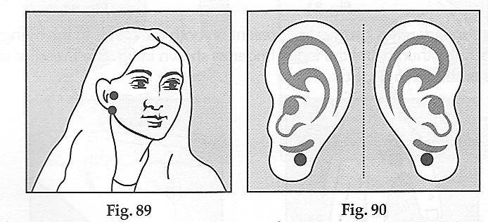 90). Pressure can be given with the thumb or finger, 2-3 times for 2 seconds. Apply pressure on the bony depression behind the ear, as shown in fig. 91.