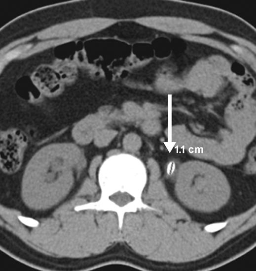 MDCT of Urinary Stone Disease A Fig. 1 23-year-old man (height, 1.79 m; weight, 89 kg; BMI, 27.78) with left-sided renal colic and microscopic hematuria.