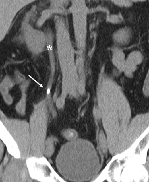MDCT of Urinary Stone Disease Fig. 2 40-year-old man (height, 1.80 m; weight, 92 kg; BMI, 28.