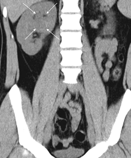 MDCT of Urinary Stone Disease A Fig. 7 24-year-old man (height, 1.79 m; weight, 75 kg; BMI, 23.41) with right-sided acute flank pain and macroscopic hematuria.