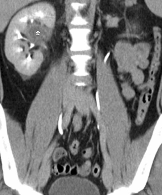 A, Coronal 5-mm MDCT image shows evidence of mass lesion (arrows) in region of calyces of upper pole of right kidney.