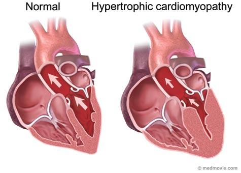 HYPERTROPHIC CARDIOMYOPATHY Most often diagnosed during infancy or adolescence, hypertrophic cardiomyopathy (HCM) is the second most common form of heart muscle disease, is usually genetically