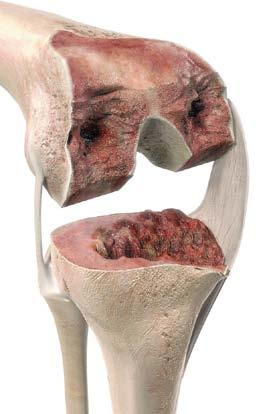 Bone DefectS IN REVISION Total Knee Arthroplasty The DePuy Orthopaedics Revision Knee System allows the surgeon to address T1/F1, T2/F2 and T3/ F3 bony defects, taking full account of the