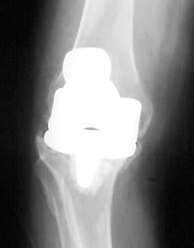 Case History Preoperative X-ray Postoperative X-ray With the central and peripheral tibial defects filled, the surgeon is able to