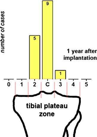4 With regard to the location of the mechanical axis of the leg in relation to the tibial plateau, before surgery, zone 1 was represented in five cases, zone 2 in eight cases and zones C and 3 were