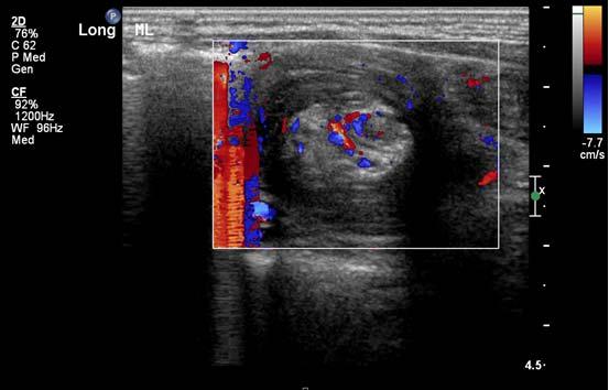 anywhere Transverse scan: eccentric semilunar hyperechoic fat and sometimes lymph nodes Pitfalls: Any cause of bowel thickening