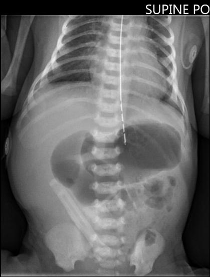 Malrotation with Midgut Volvulus Intestinal malrotation = Failure of rotation and fixation of bowel early in the embryo Short fixation of mesentery susceptible to volvulus around a vascular stalk