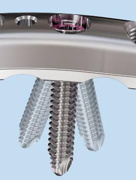 Variable angle locking Variable angle locking screws allow unlimited screw angulation within a 30 cone to: Adapt screw angulations to patient anatomy Capture specific fracture fragments Adjust screw