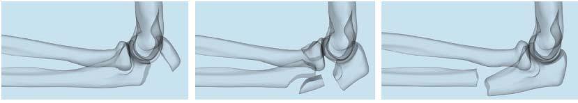 Recommended Uses for Olecranon plates Proximal Olecranon Plate Olecranon Plate Extra-articular Proximal Ulna Plate For very proximal, short, comminuted avulsion type fractures fractures that are