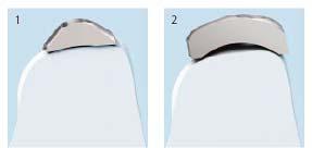 Plate design Rounded edges and an improved anatomical plate fit minimize the