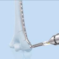 of the drill guide under fluoroscopy Variable Angle Nominal Angle - Use the