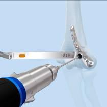 the drill guide under fluoroscopy Variable angle Nominal angle - Use the depth