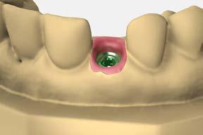 cement-retained restorations cement-retained single crowns using cementable abutments Cement-retained implant restorations are similar to conventional crowns and bridges.