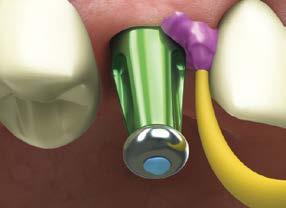 The clinician makes an implant-level impression; the lab prepares the abutment and fabricates the restoration.