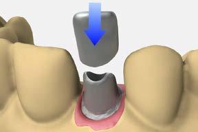 cement-retained restorations cement-retained single crowns using cementable abutments 6 Lab