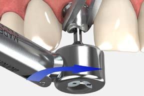 cement-retained restorations cement-retained single crowns using cementable abutments 9 Seat the prepared abutment Sanitize modified abutment and crown per standard clinical procedure.