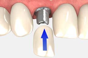 Irrigate the internally-threaded connection of the implant and dry. Place the modified abutment and abutment screw onto the implant with an.050 (1.25mm) hex driver and hand tighten.