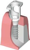 5.a Closed tray impression procedure snap-on RN Implant shoulder Ø 4.8 mm WN Implant shoulder Ø 6.5 mm Art. No. 048.070V4 Art. No. 048.017V4 Art. No. 048.124 Art. No. 048.095 Art. No. 048.013 Art. No. 048.171 The closed-tray impression-taking procedure for implant shoulder Ø 4.