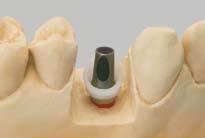 3a 3b 3c Important: Before delivery of the work to the dentist, the lateral seal of the screw opening must be removed to ensure that no residue is left, and the abutment must be