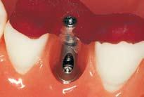 Finally, remove the transfer aid and fit the superstructure onto the implant. The abutment screw is tightened with the SCS screwdriver along with the ratchet (046.