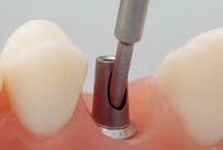Tighten the crown with a torque of 15 Ncm using a SCS occlusal screw or a SCS guide screw shortened to occlusal level.