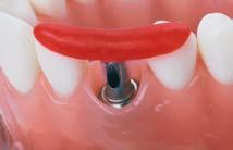 Loosen the WN synocta angled abutment using the SCS screwdriver and remove from the analog.