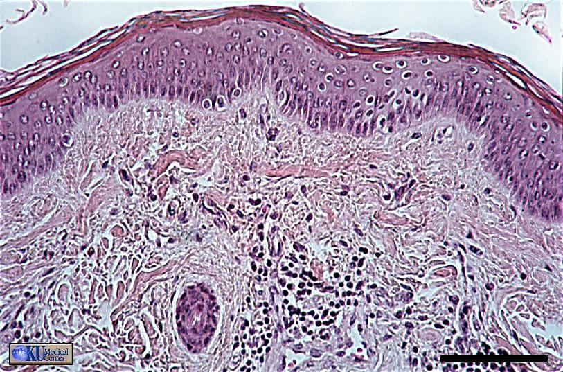 Stratified Squamous in the Epidermis of the Skin Flattened, cornified cells cover the surface as the stratum corneum.