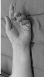 of index DIP and thumb IP flexion, PT Direct trauma to
