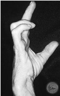 lumbricals to ring and small, hypothenar muscles) Median nerve innervation of