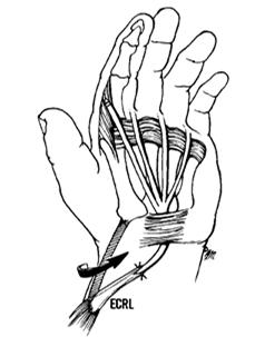 extended by graft into 4 slips, passed through the carpal tunnel and volar to the deep transverse