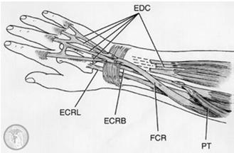 ECRB/L to restore wrist extension Palmaris