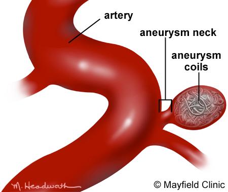 Aneurysm Embolization: Coiling Overview Coil embolization is a minimally invasive procedure to treat an aneurysm by filling it with material that closes off the sac and reduces the risk of rupturing