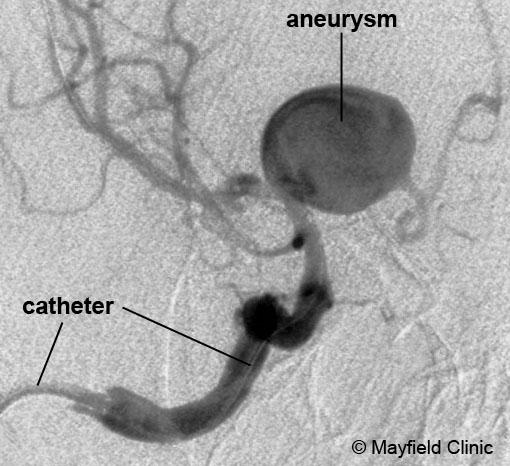 Figure 3. Angiogram shows a catheter in the internal carotid artery. A flush of dye shows blood filling an aneurysm. Figure 2. During an angiogram.