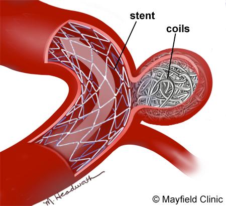 Some aneurysms with a wide neck or unusual shape require a stent to help hold the coils in place (Fig 6).