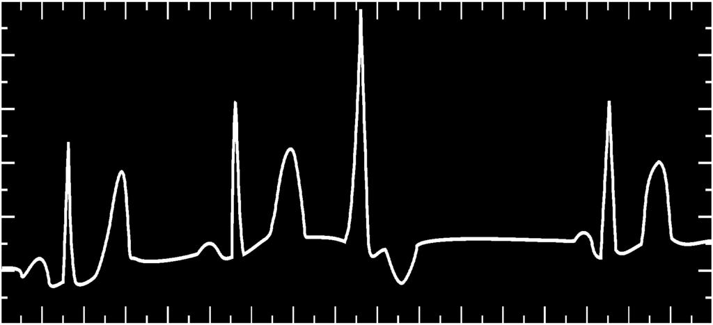 EKG: Can all components be identified in each beat?