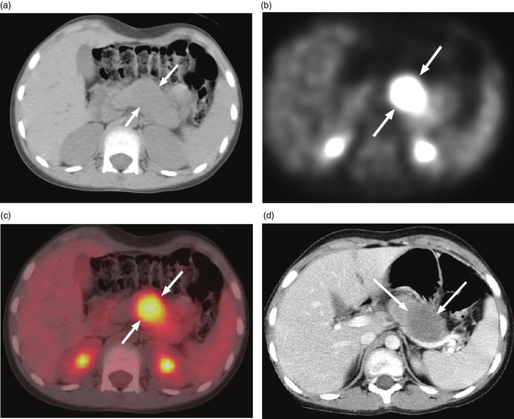 90 M.B. McCarville Figure 2 Axial abdominal PET-CT images of a 10-year-old girl with metastatic alveolar rhabdomyosarcoma. (a) Axial CT image at level of a pancreatic metastasis.