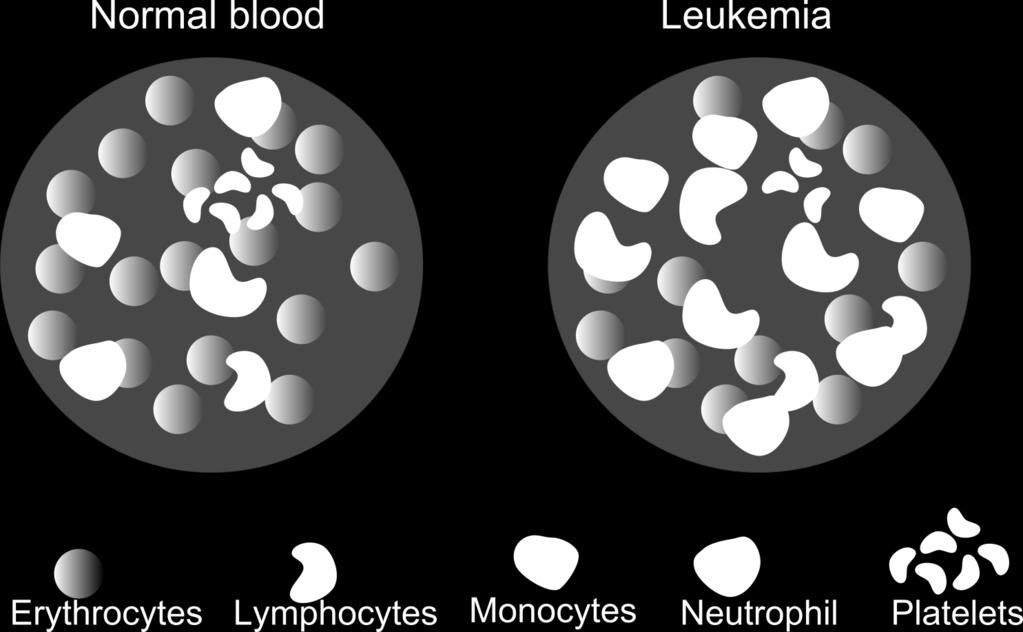 lymphoblasts (immature white blood cells) start